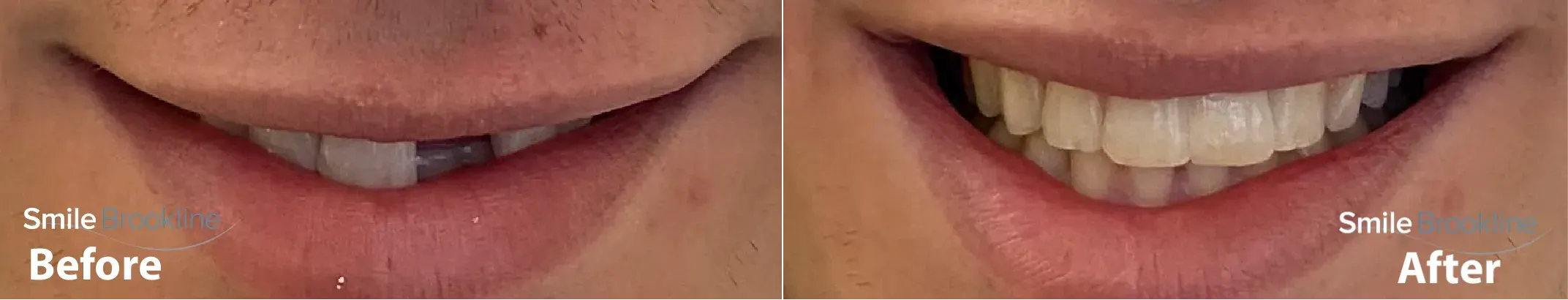 Dental Bridges - Before and After