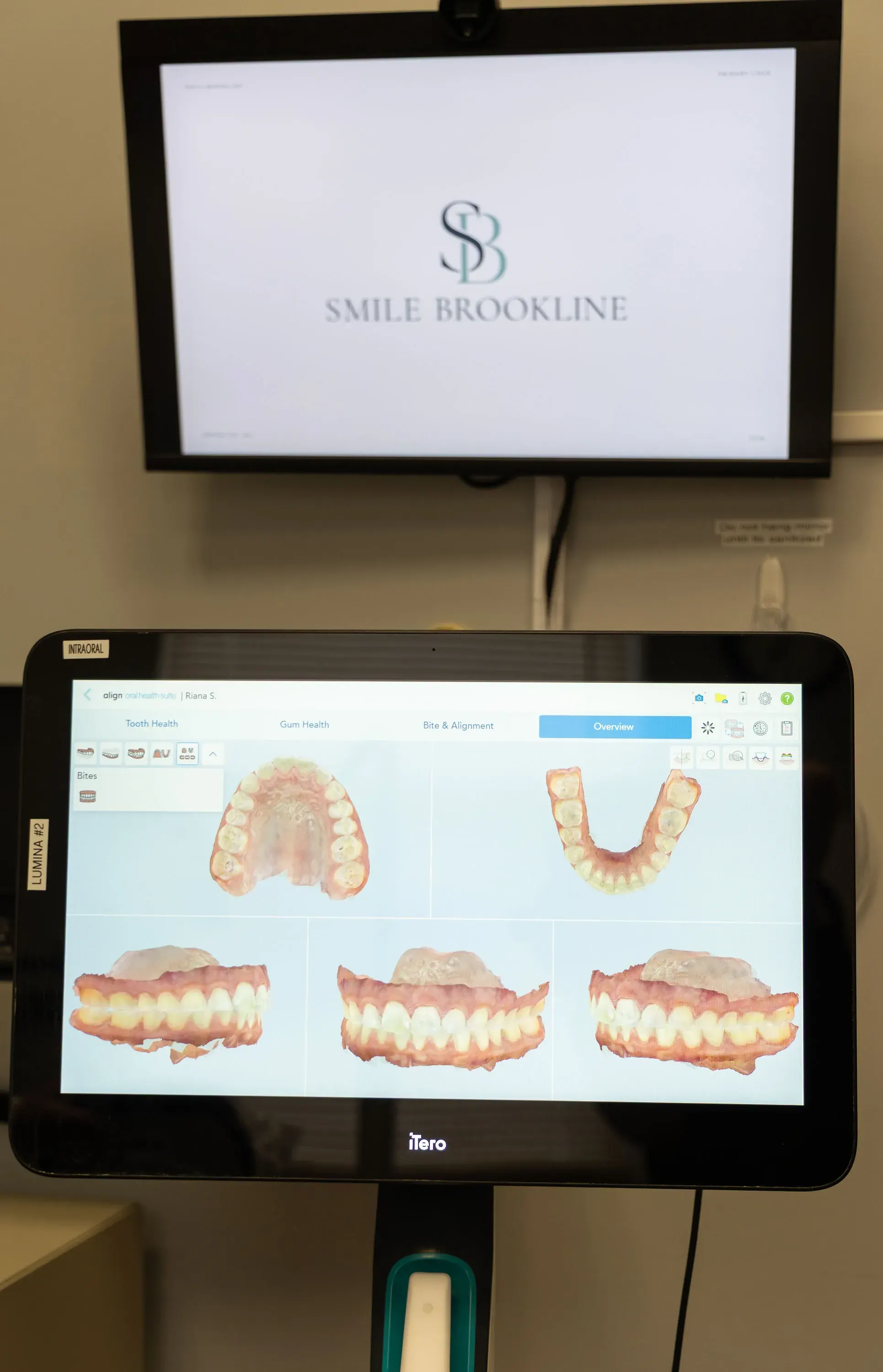 Before and after a tooth-coloured filling repairing decay at Smile Brookline in Brookline MA