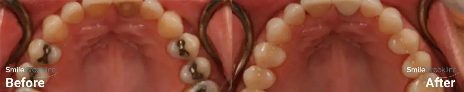 Dental Fillings - Before and After