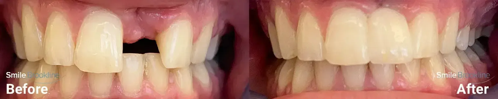 Dental Bridges - Before and After