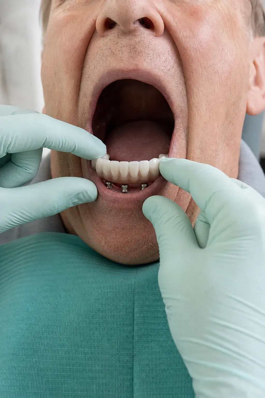 Before and after implant-supported denture treatment restoring stable function at Smile Brookline