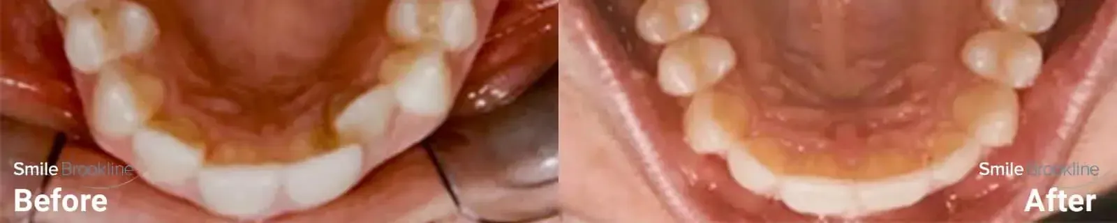 Invisalign