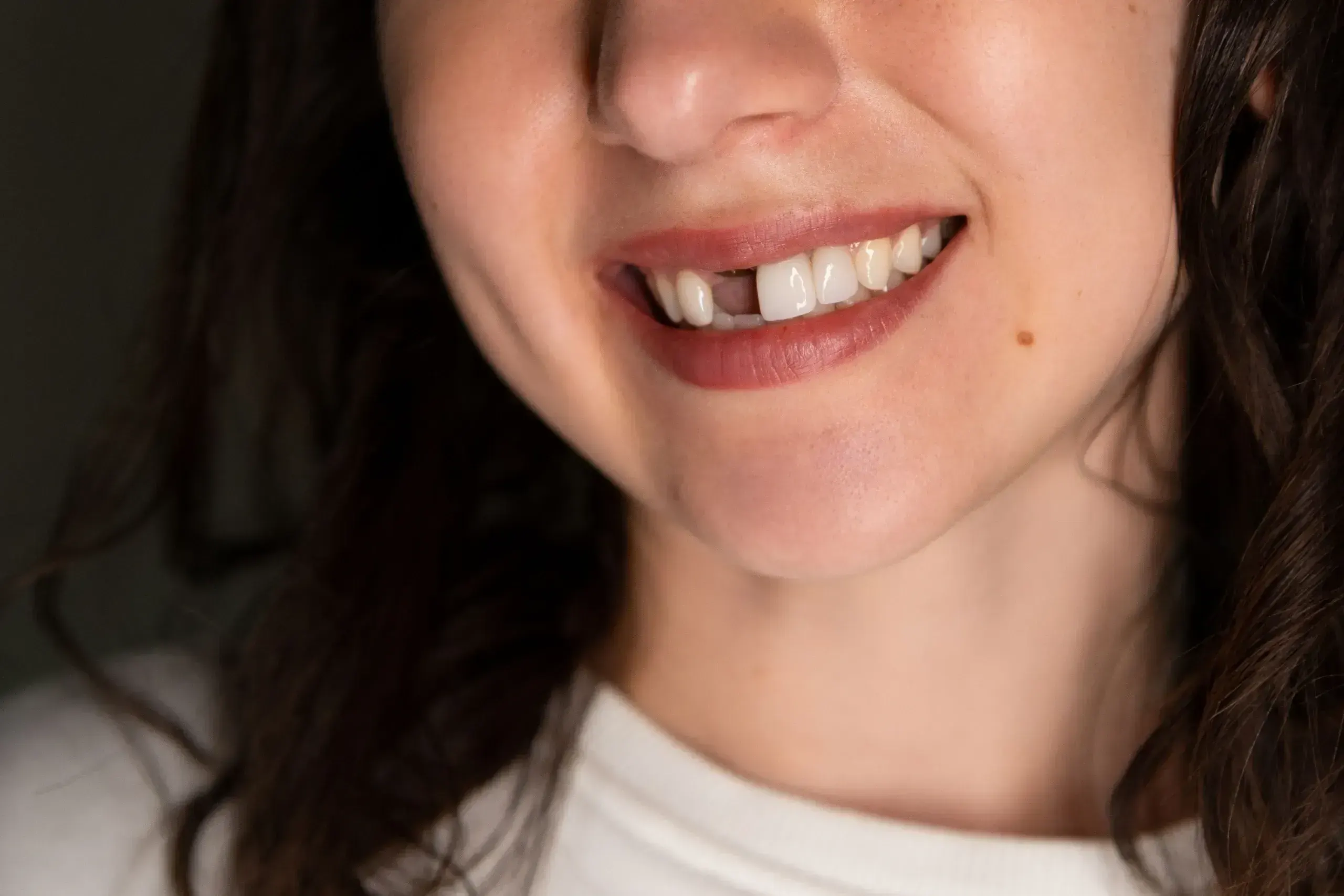 Missing teeth replacement options in Brookline MA discussed at Smile Brookline Beacon Street