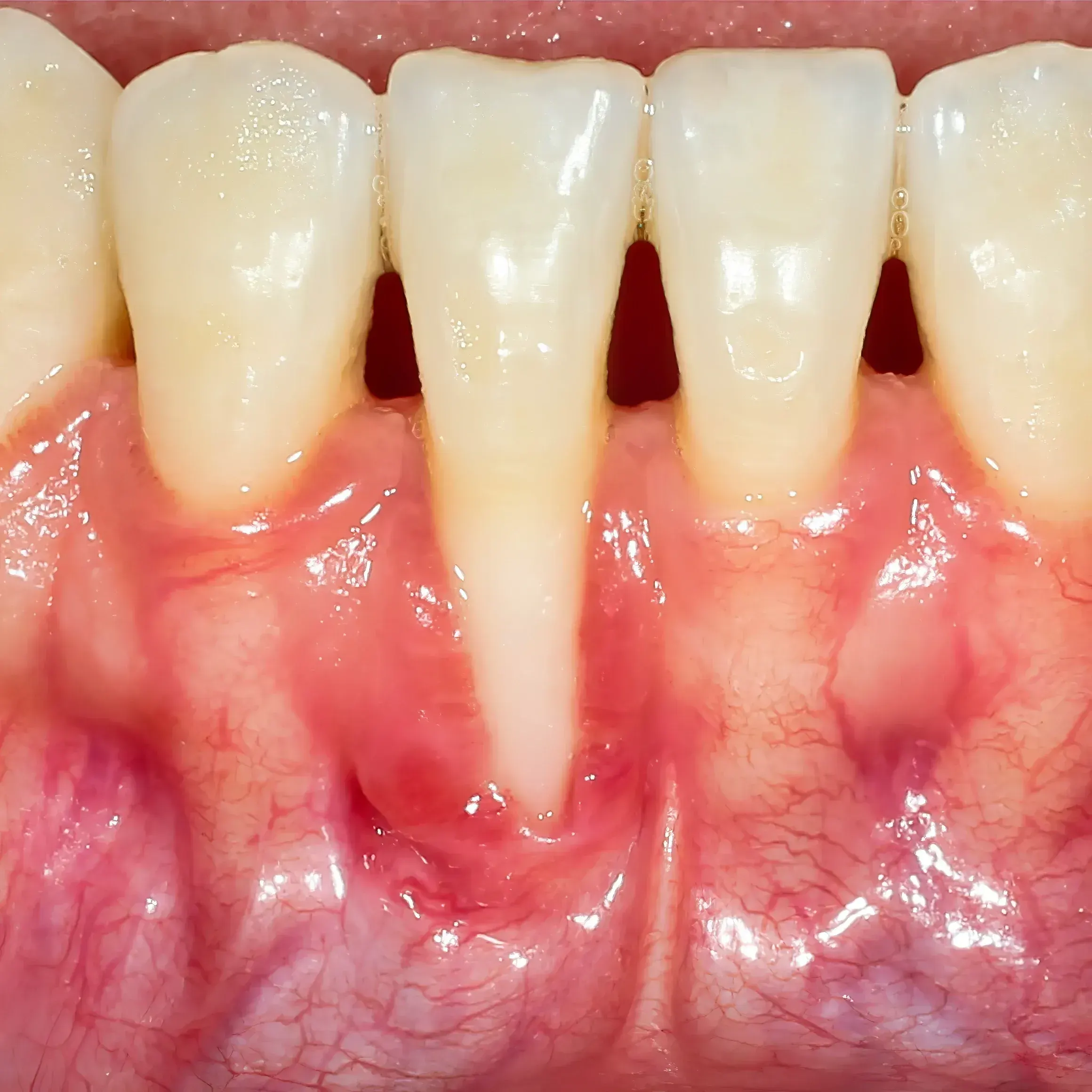 Close-up of receding gums exposing tooth roots before treatment at Smile Brookline Brookline MA