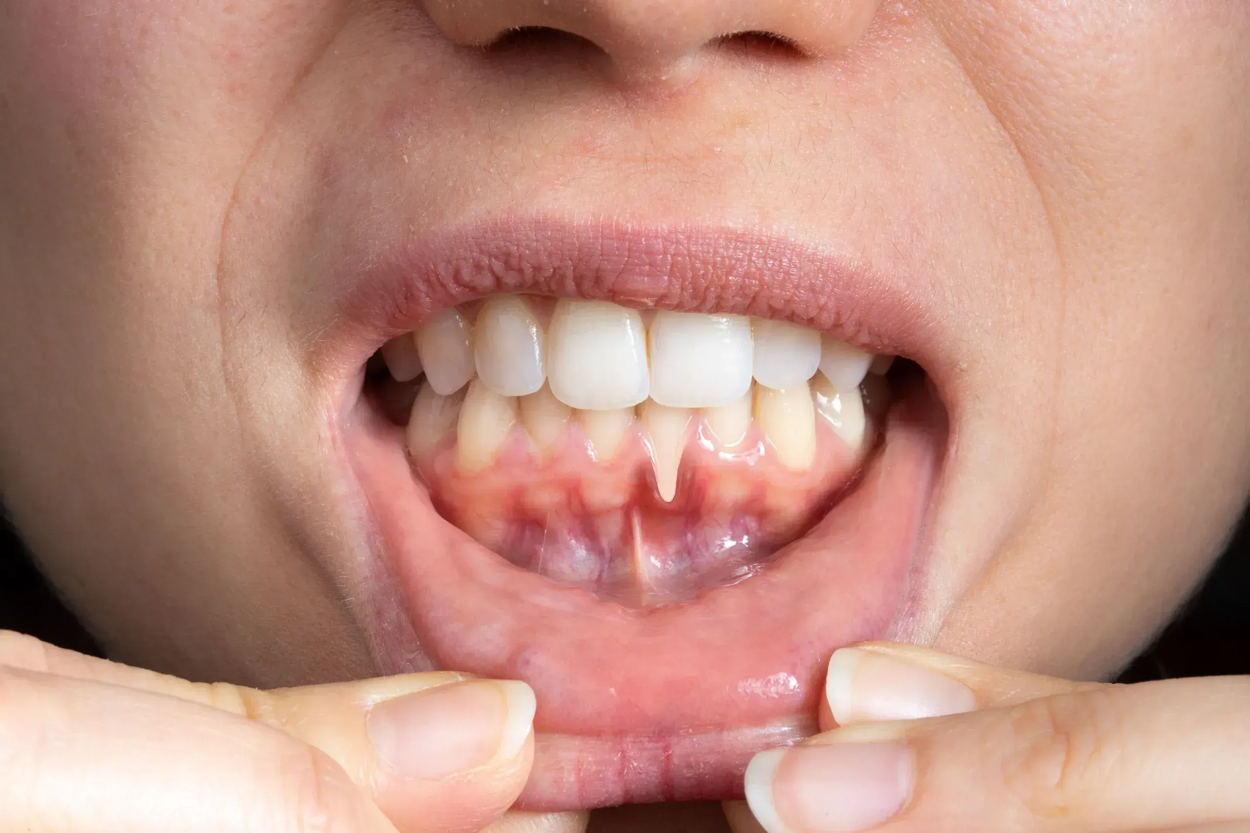 Gum recession treatment in Brookline MA showing exposed tooth roots at Smile Brookline
