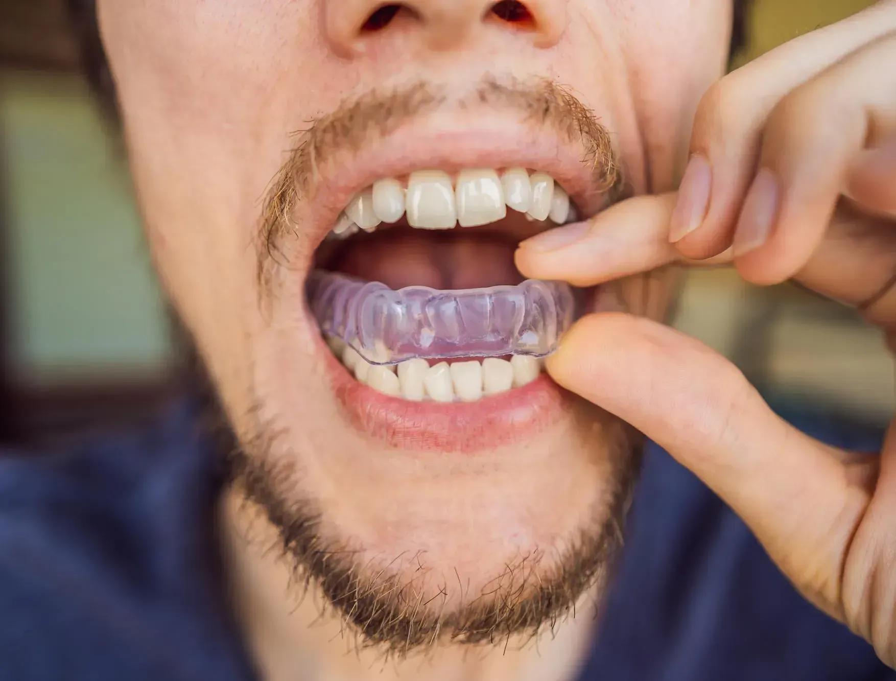 Worn tooth surfaces caused by nighttime grinding examined at Smile Brookline in Brookline MA