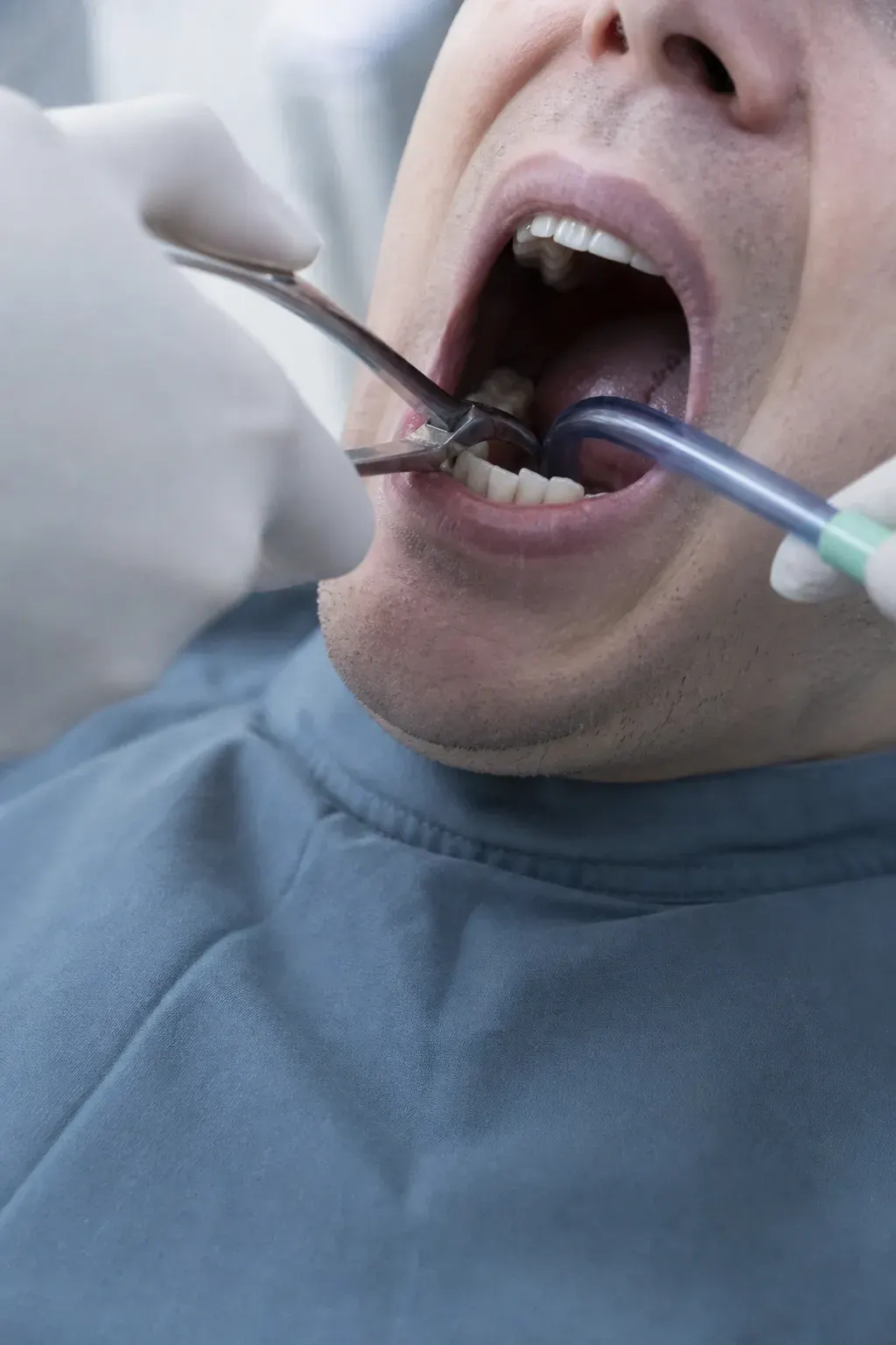 Before and after tooth extraction with socket preservation graft at Smile Brookline Brookline MA
