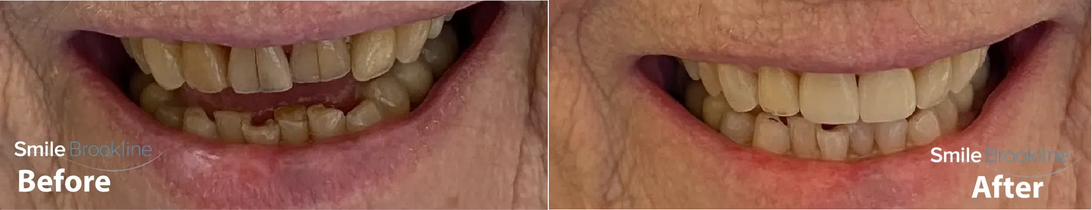 Dental Crowns - Before and After