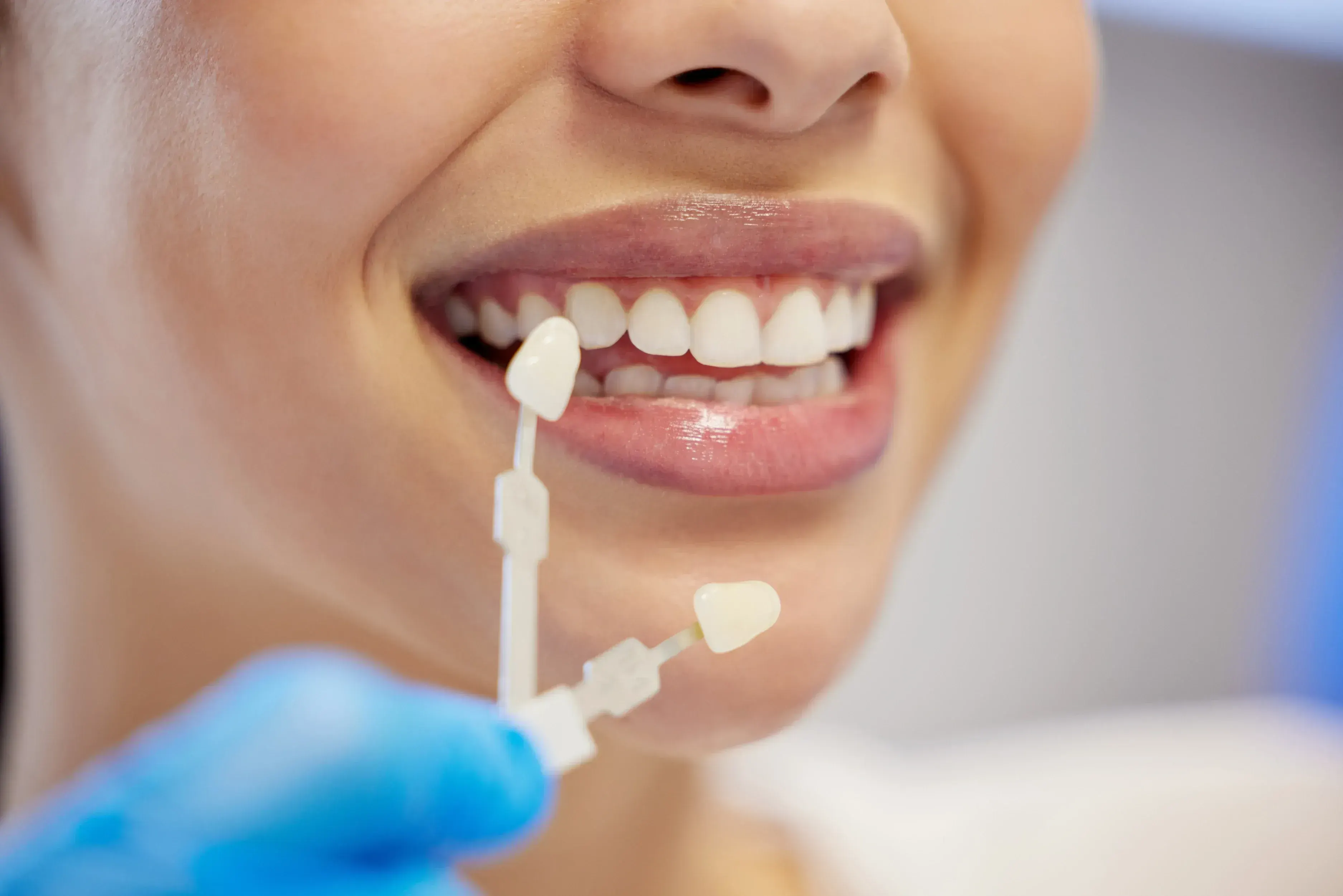 Porcelain veneers being shade-matched during cosmetic treatment at Smile Brookline MA